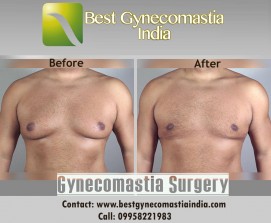 Gynecomastia / Male Breast  Surgery