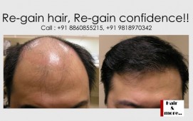 Hair Transplant