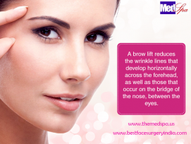 Brow Lift Surgery in Delhi