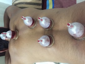 Cupping therapy