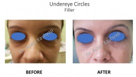 Under Eyes Dark Circles Treatment