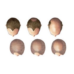 Ayurvedic Hair Loss Medicine