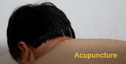 Acupuncture