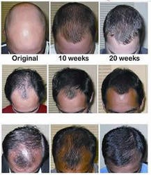 Hair Growth Treatment