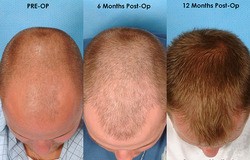 Hair Transplant Clinic