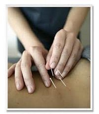 Acupuncture