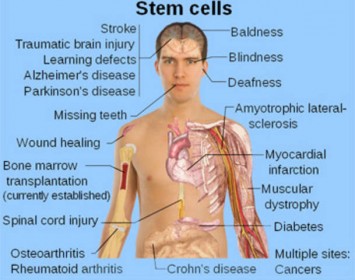 Stem Cell Therapy