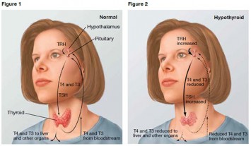 Ayurvedic Thyroid treament