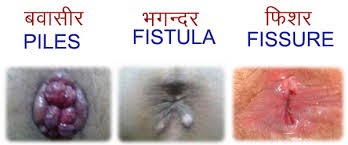 Ayurvedic Treatment for Piles, Fissure or Fistula