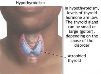 Hypothyroidism