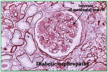 Diabetic Nephropathy