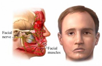 Facial Palsy