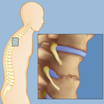 Spondylitis