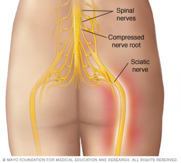 Sciatica