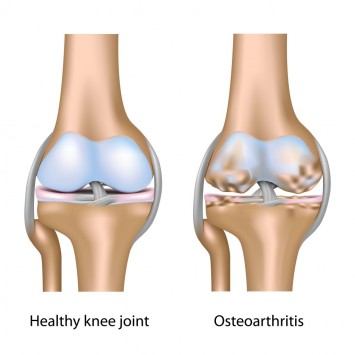 OsteoArthritis