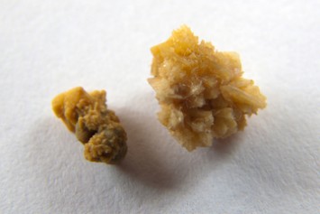 Kidney Stones