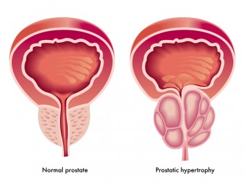 Prostate Enlargement