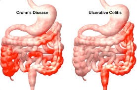 Ulcerative Colitis