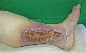 Varicose Ulcers