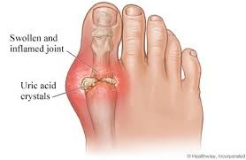 Blood Uric Acid