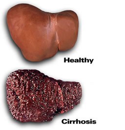 Alcoholic Liver Disease