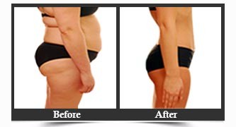 Liposuction