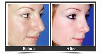 Nose Reshaping