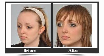 Cheek Implant