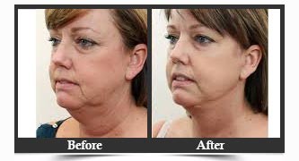 Neck Lift