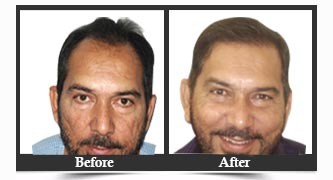 Hair Transplantation