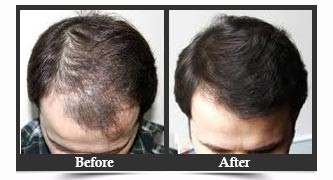 FUT Hair Loss Treatment