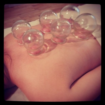 CUPPING THERAPY