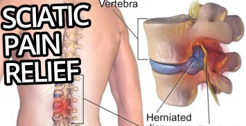 Sciatica