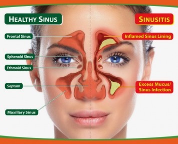 Sinusitis Ayurvedic Treatment