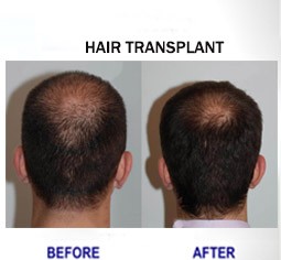 Hair Transplant in Delhi