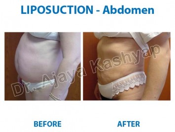 Liposuction Surgery in Delhi