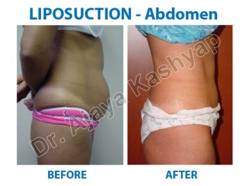 Liposuction Surgery