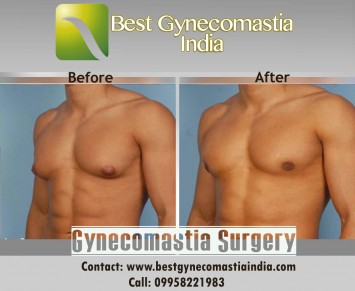 Gynecomastia/ Male Breast Surgery