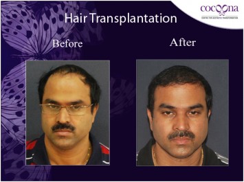 Hair Transplant